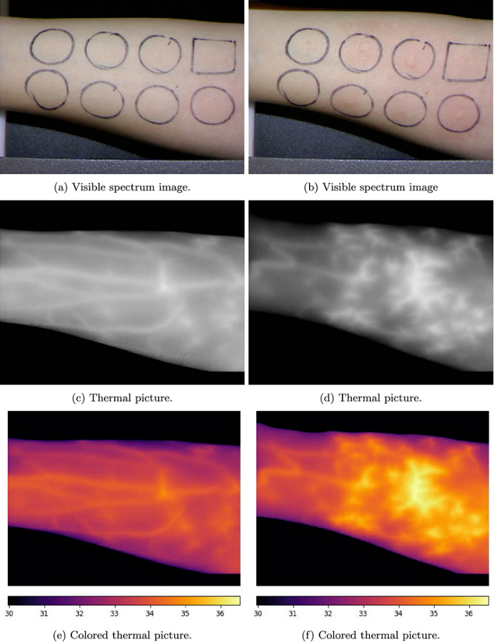 pictures of the patient's forearm before and after the application of the allergen